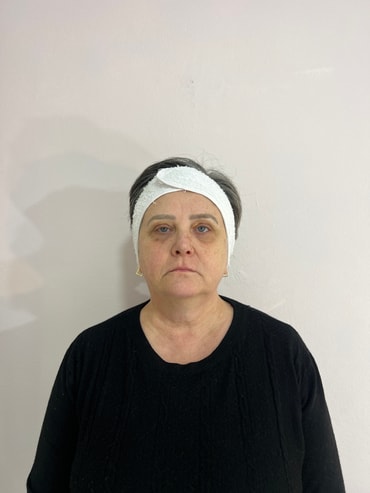 Paciente antes da harmonização facial - lado direito
